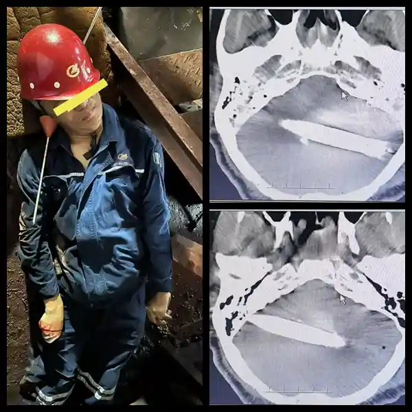 钢筋贯穿颅脑，医生双侧开颅上演生死营救